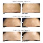 Cấy chỉ tơ tằm Chitossil 10 lọ Hàn Quốc kéo căng, dưỡng trắng