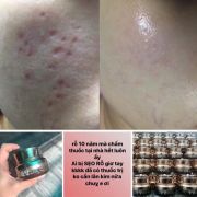 Kem trị sẹo rỗ đông y Genie Non Fix Skin Hàn Quốc hũ 30g