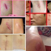 Kem trị sẹo Rejuvasil Scar Gel chuyên trị sẹo lồi, phì đại