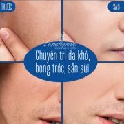 Tinh chất cấp ẩm Ahohaw Inten-Cure Hydro Ampoule Hàn Quốc 
