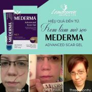 Kem trị sẹo Mederma Advanced Scar Gel của Mỹ tuýp 20g