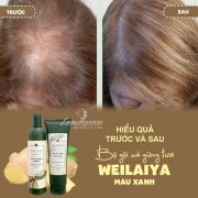 Bộ gội xả gừng Weilaiya, giảm gãy rụng, giúp tóc dày mượt