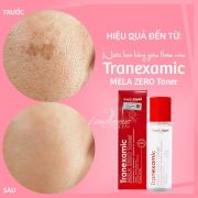Nước hoa hồng Tranexamic Mela Zero Toner Angels Liquid 150ml