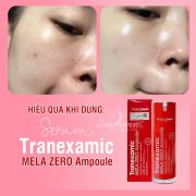 Serum Tranexamic Mela Zero Ampoule Angel's Liquid chai 30ml